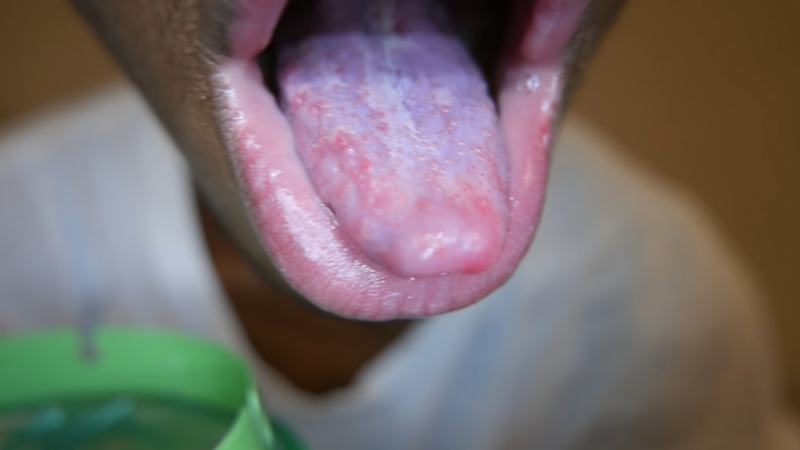 A Painful Geographic Tongue (1)