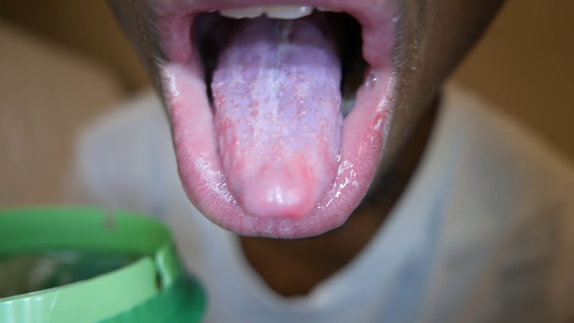 A Painful Geographic Tongue