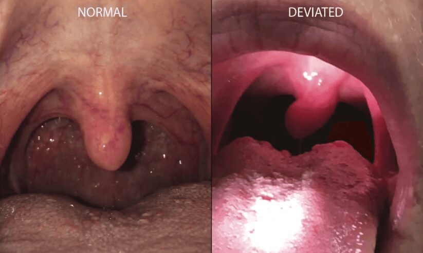 normal and deviated uvula