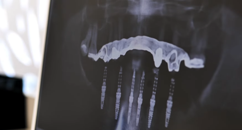 Dental X-Rays