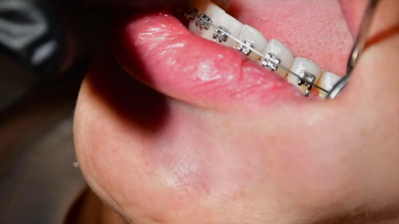 Effectiveness of Traditional Braces in Complex Cases