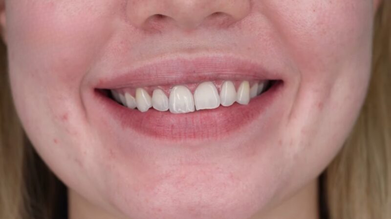 Teeth Whitening with Purple Toothpaste