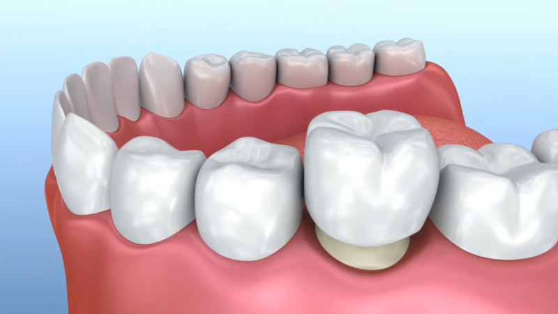 What Are CEREC Crowns?