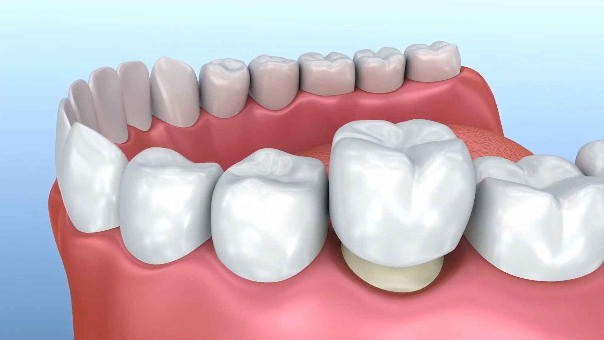 What Are CEREC Crowns and How Do They Work? - Water Town Dental Health