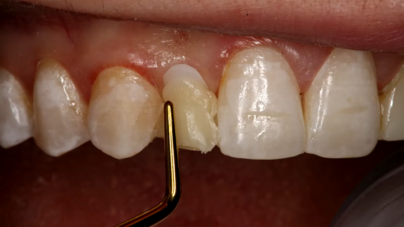 A Close-Up Image Showing Dental Bonding Being Applied to A Cracked Front Tooth Using a Dental Instrument