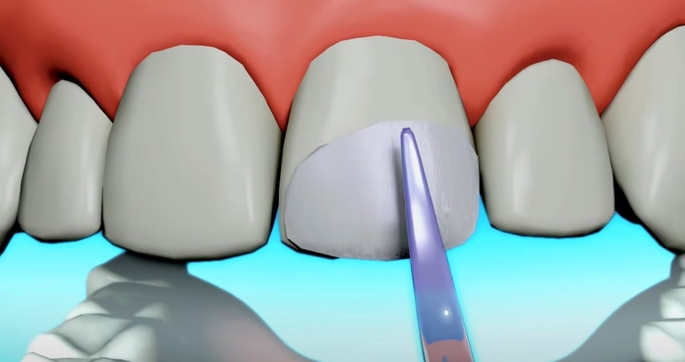 Dental Bonding is Minimally Invasive Procedure