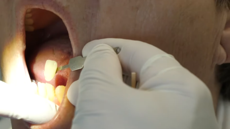 A Close-Up Image of A Dental Crown Being Placed Over a Cracked Tooth