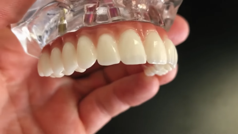 A Close-Up View of A Dental Model Showcasing a Set of Artificial Teeth with A Focus on Tooth Extractions and Implants