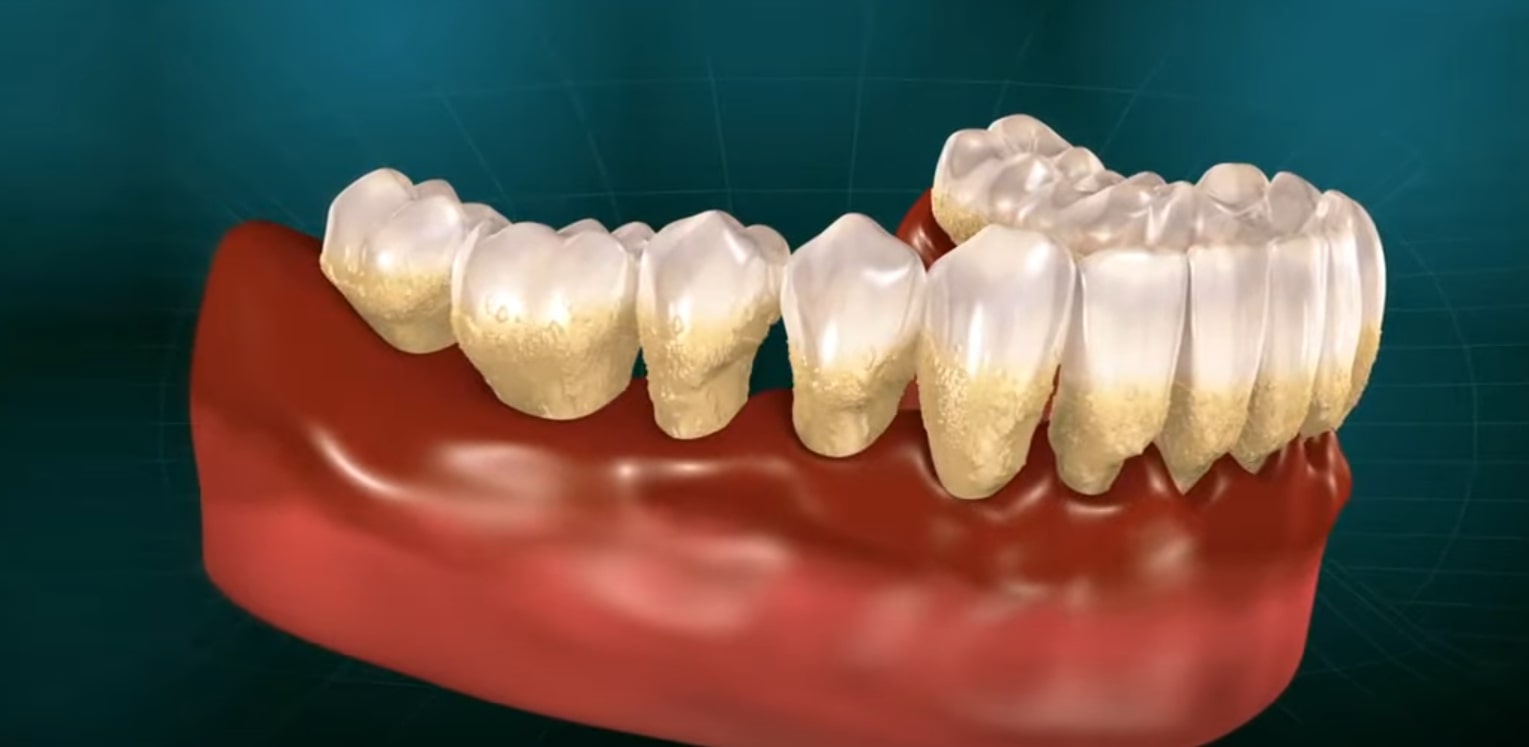 Periodontitis - Gum Disease