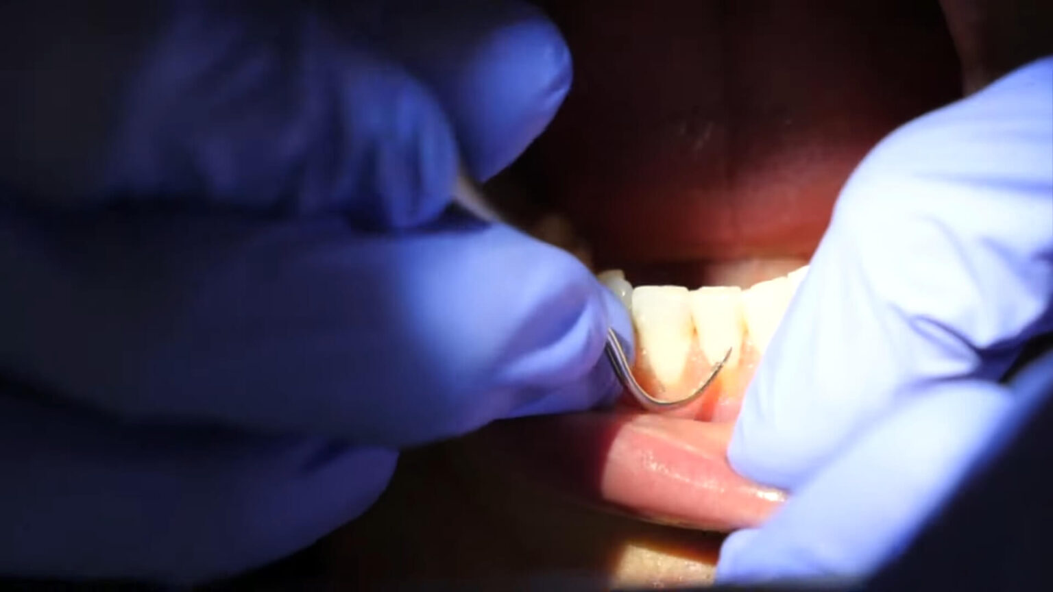 Scaling and Root Planing - What to Expect During a Deep Teeth Cleaning ...