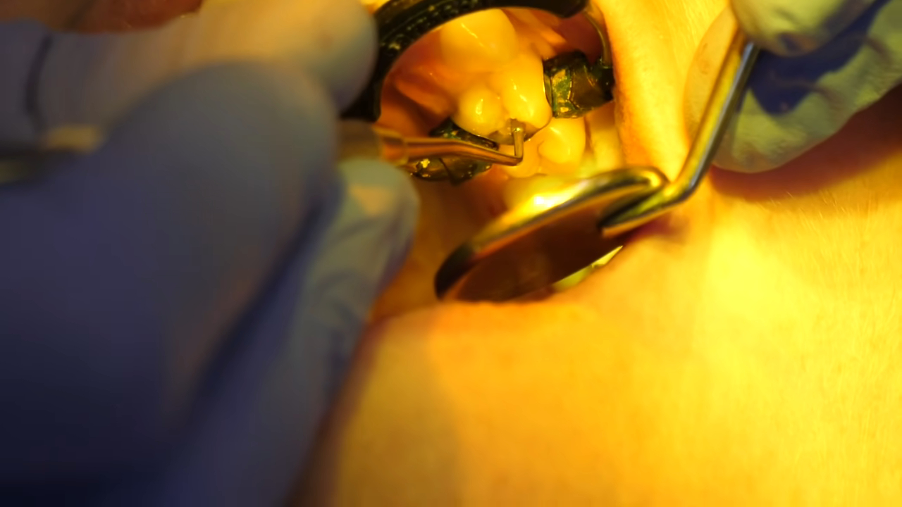 Dental filling procedure in progress with dentist tools and a close-up view of a tooth being treated